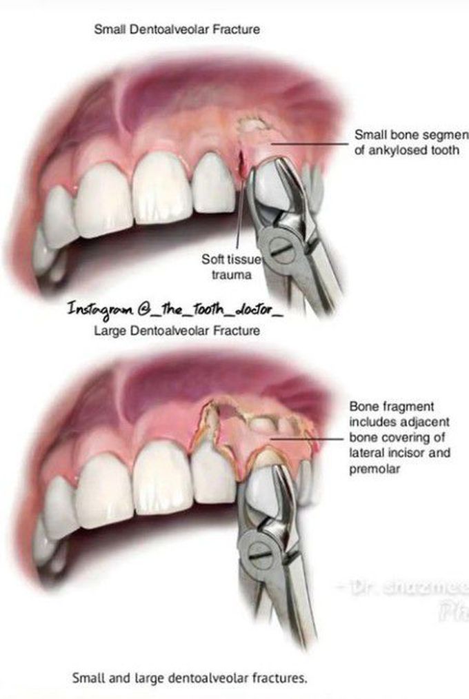 Dentoalveolar Fracture