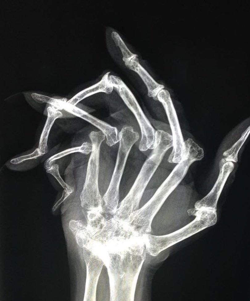 Mangled Hand Xray