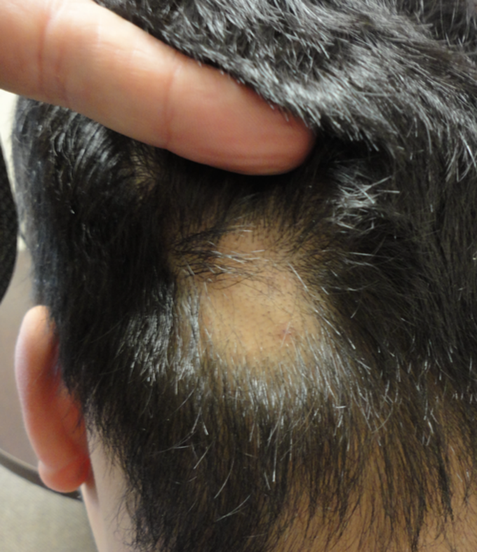 ALOPECIA AREATA