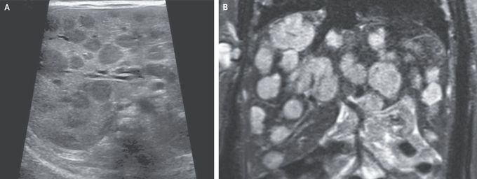 Infantile Hepatic Hemangiomas