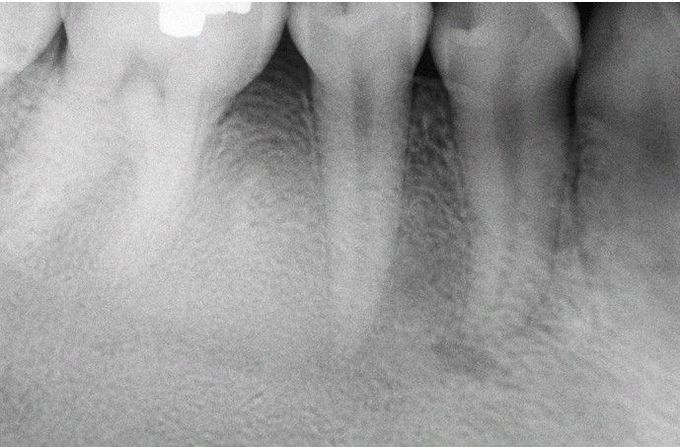 Fibrous Dysplasia.