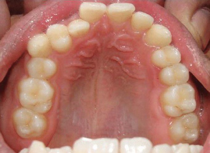 Transposition of Canine With 1st premolar