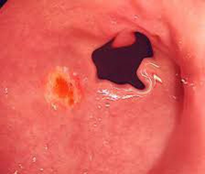 Duodenal ulcers