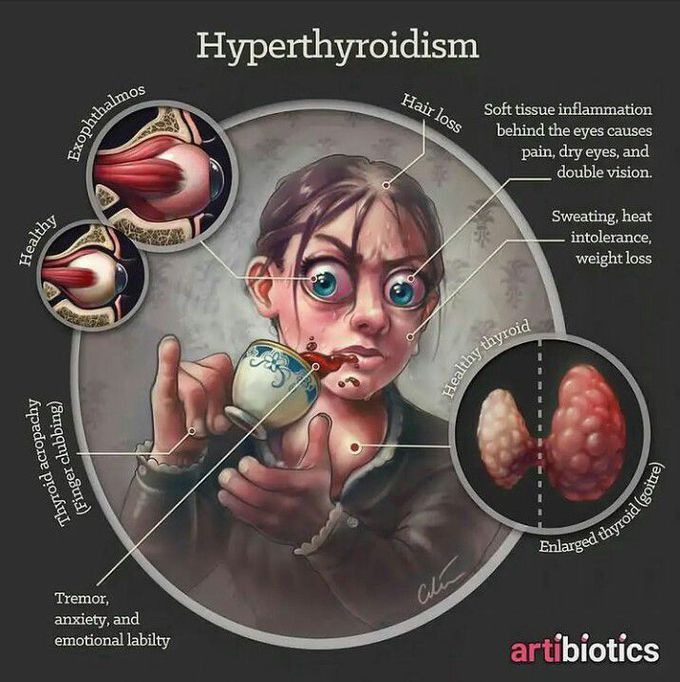 Hyperthyroidism