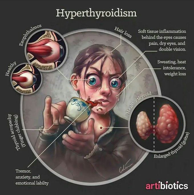 Hyperthyroidism Medizzy 