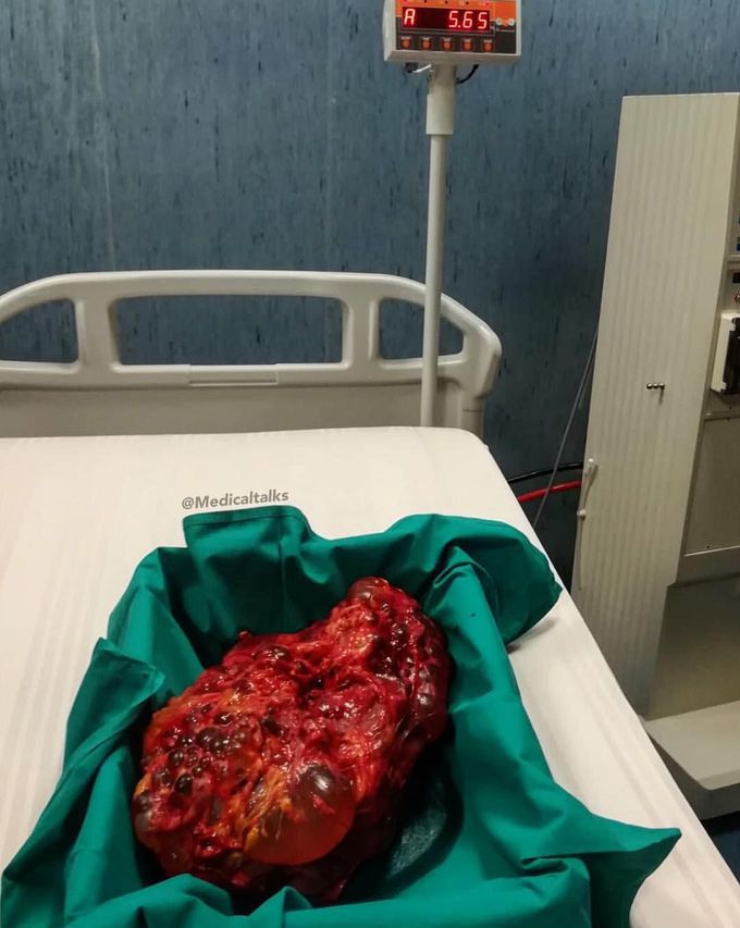 Polycystic kidney weighting a whopping 5.65 kg!! 