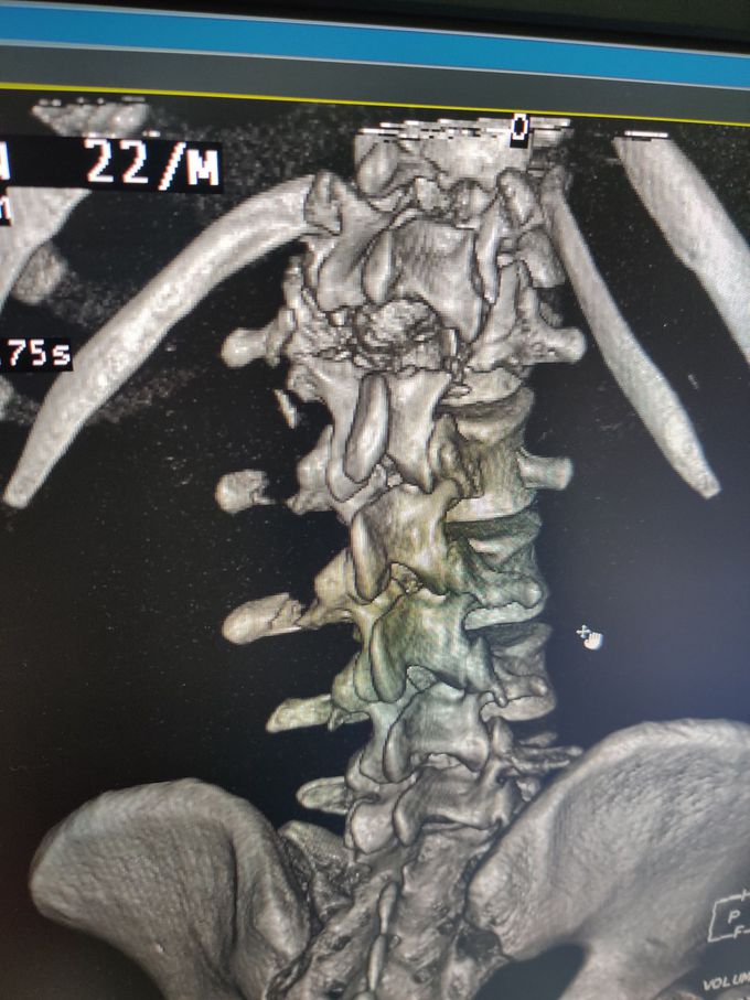 History of fall from height L1 compressed Fracture