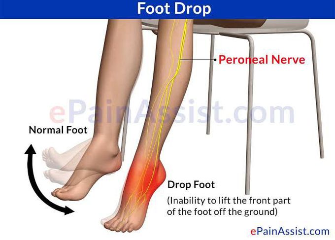 Foot drop injury