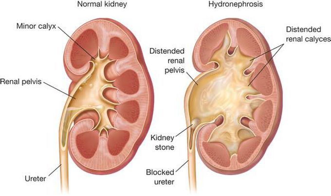 Symptoms Of Hydroureteronephrosis  
The following are the symptoms of hydroureteronephrosis:

Swelling of abdomen
Flank pain
Pain or discomfort during urination
Pain in the lower back, which may be sudden or persistent.
Change in frequency of urination- could be less or more than normal
Feeling weak
Nausea
Vomiting
Sweating
Urinary tract infection (UTI)
Fever
Loss of control over urination
Blood or pus discharge in urine