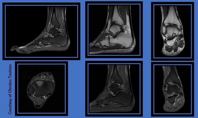 High resolution ankle MR Imaging