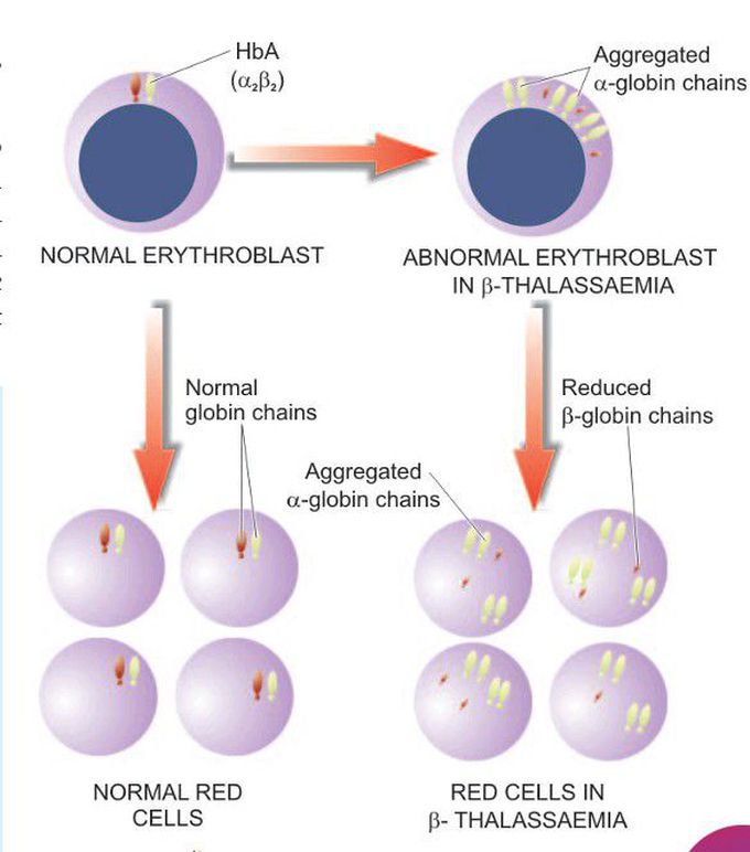 β-thalassaemia major.
