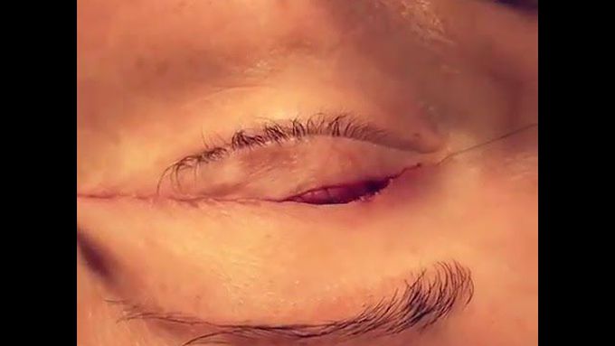 A perfect suturing for blepharoplasty