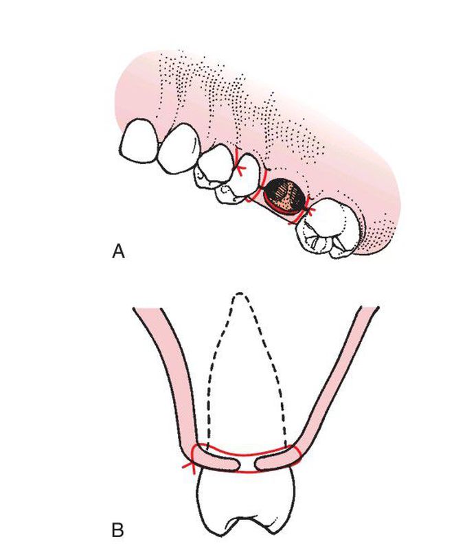 Sutured flap