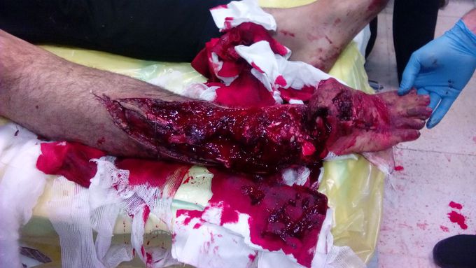 Trauma case