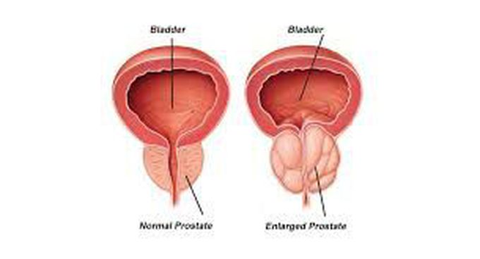 Treatment for benign prostatic hyperplasia