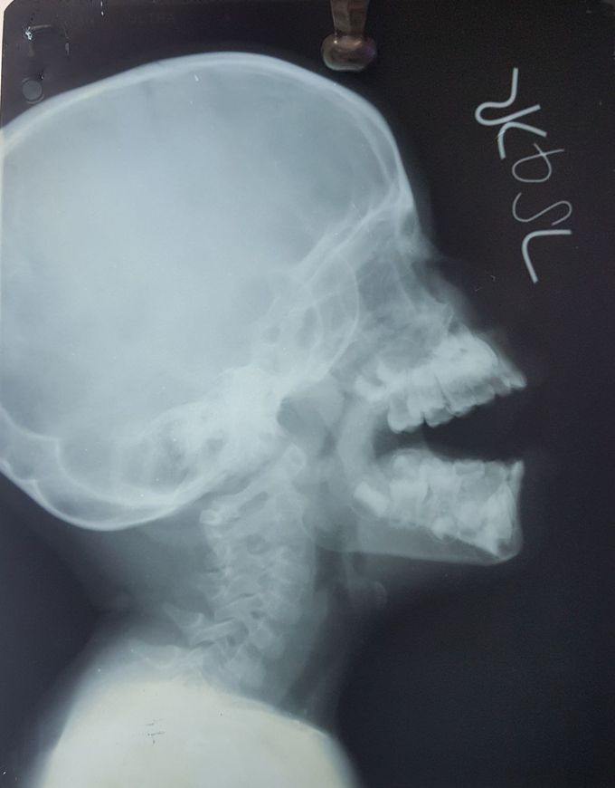 Lateral X ray Head and Neck