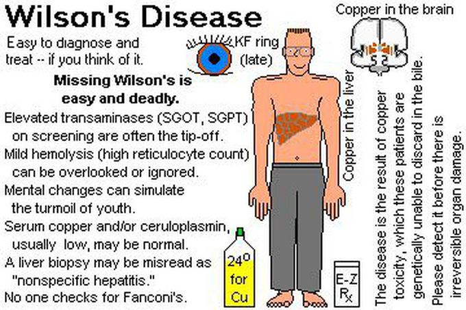 Wilson'S Disease 🙂