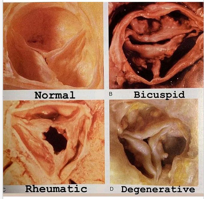 Aortic valve