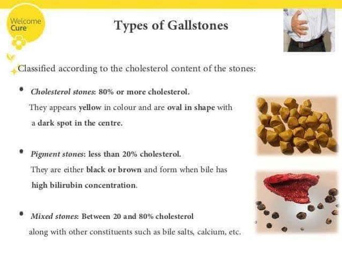 Types of gall stones