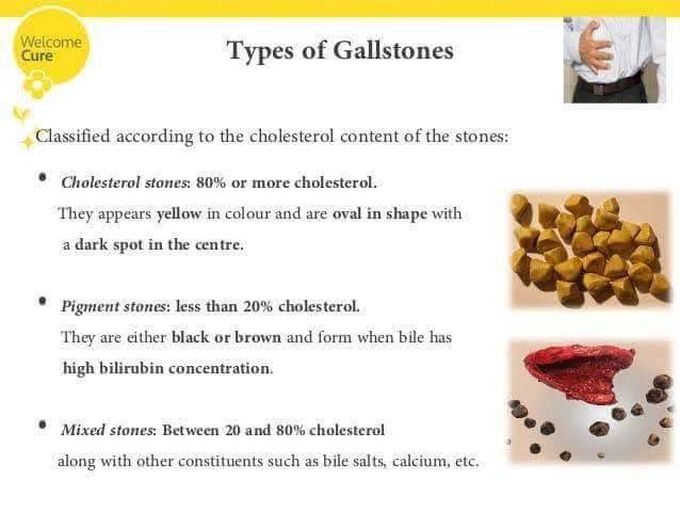 Types of gall stones - MEDizzy