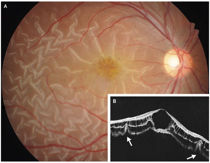 Retinal Detachment in X-Linked Retinoschisis