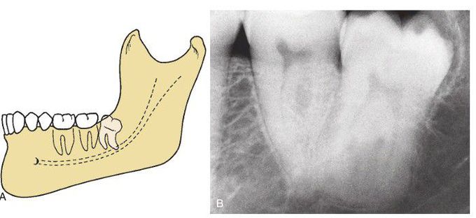 Distoangular impaction