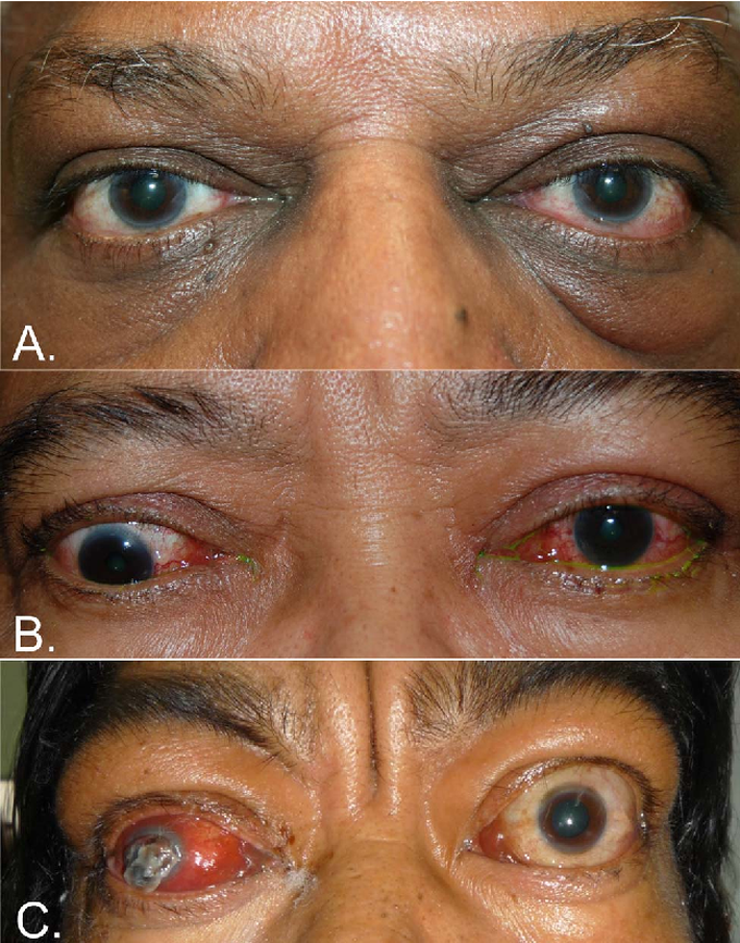 Thyroid Eye Disease (TED)