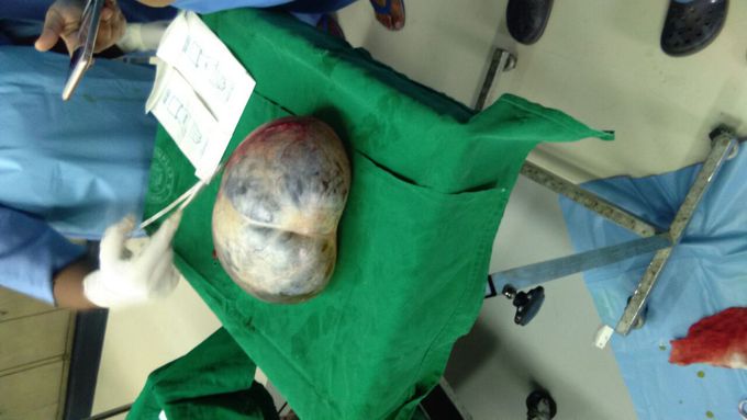 Utirine tumour