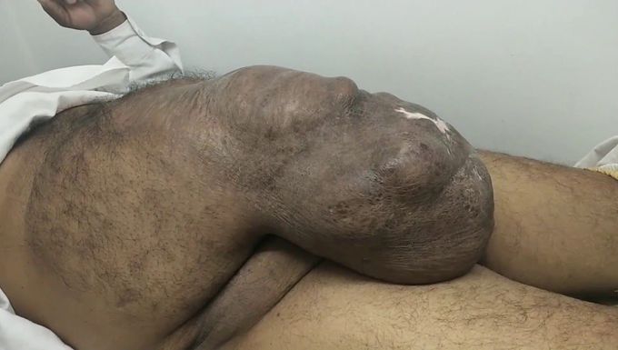 Exceptionally Big Incisional Hernia of the anterior abdominal wall