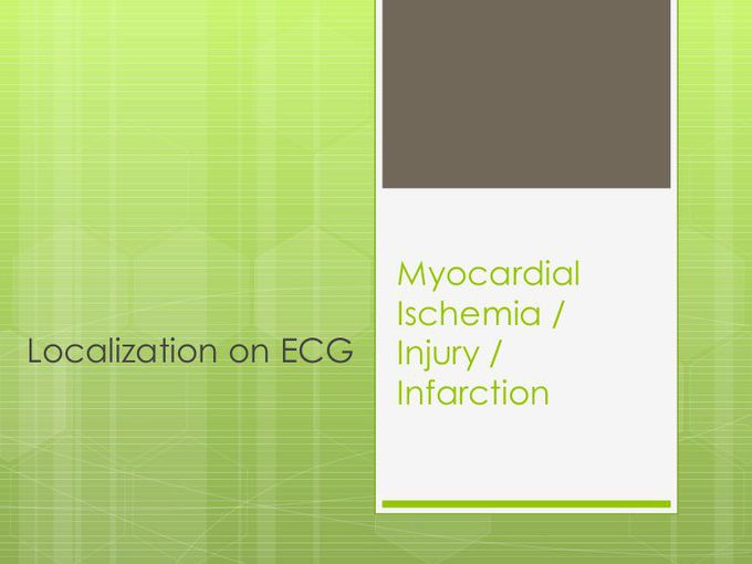 Localization of MI on ECG
