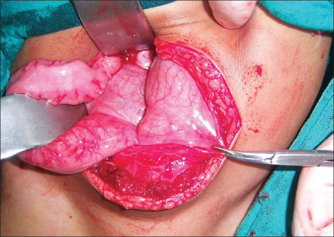 Operative photograph showing the anterior sacral meningocele with displacement of urinary bladder and sigmoid colon