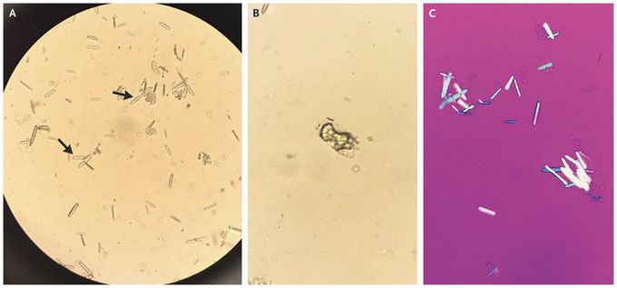 Calcium Oxalate Crystals in Ethylene Glycol Toxicity