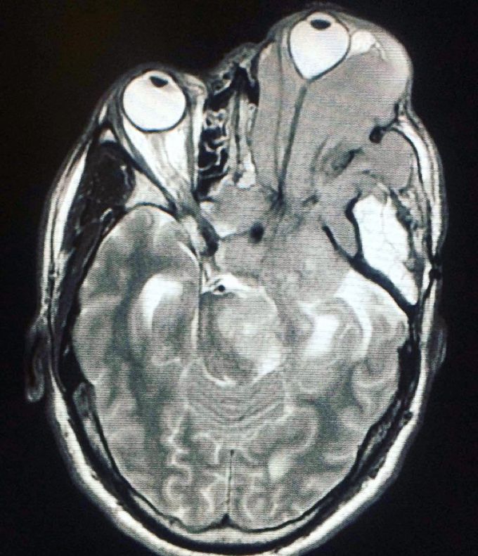 Extracranial meningioma