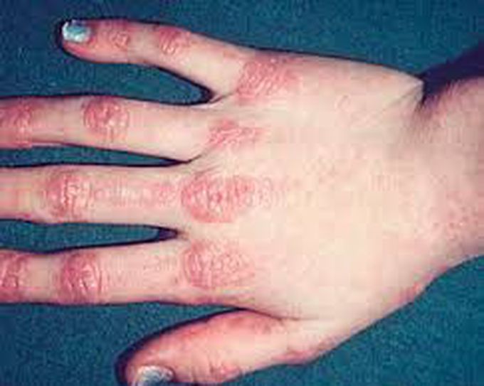 Dermatomyositis