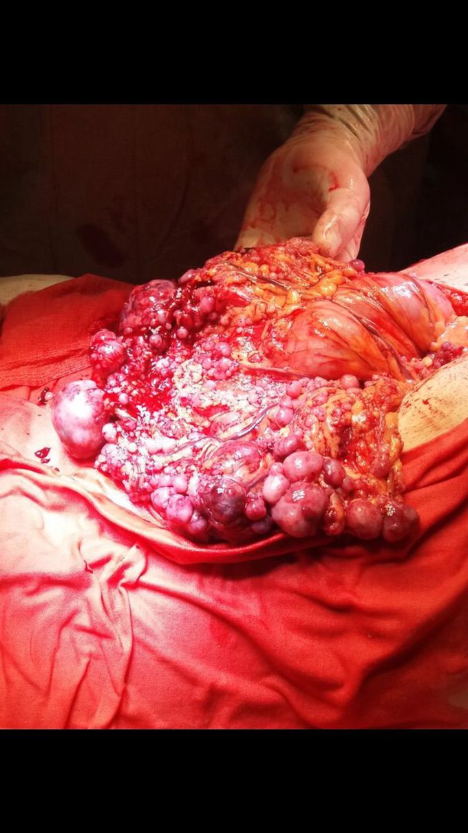Peritoneal carcinomatosis