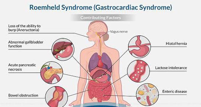 These are the factors for Roemheld syndrome