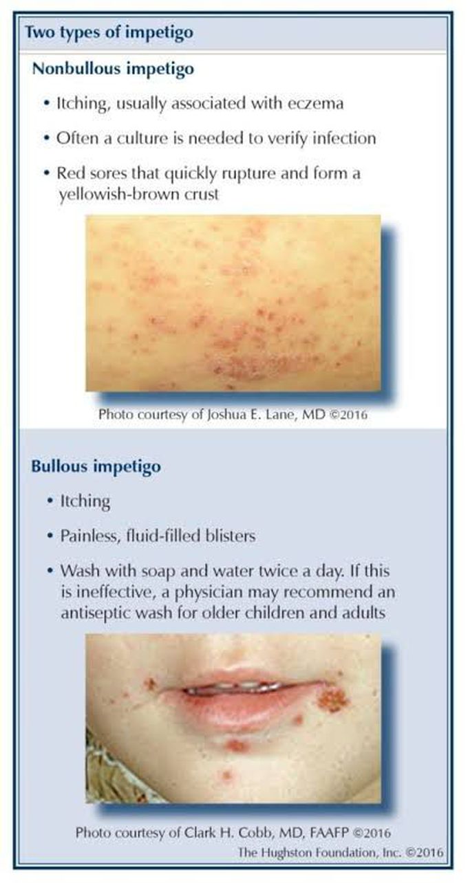 Types of Impetigo