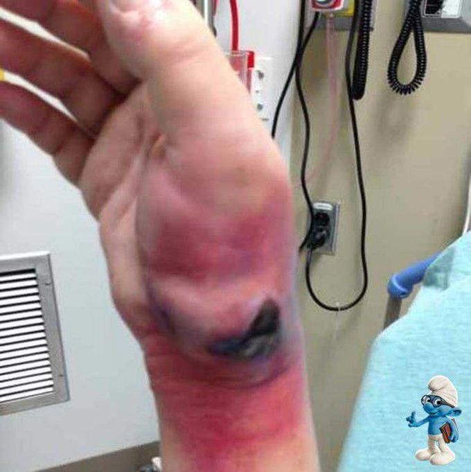 Wrist abcess due to drug injection