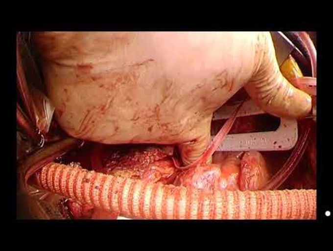 Treatment of an Aortoesophageal Fistula
