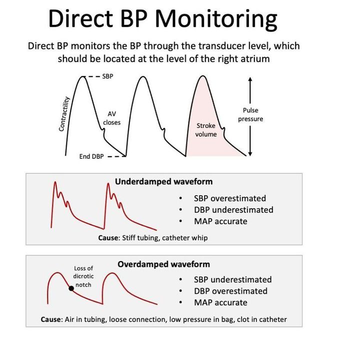 Direct BP Monitoring