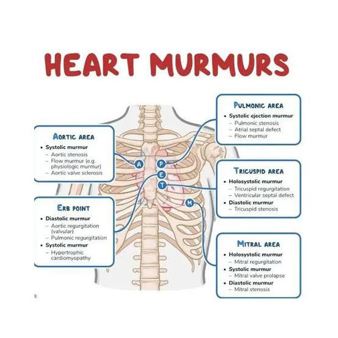 Common Heart Murmur