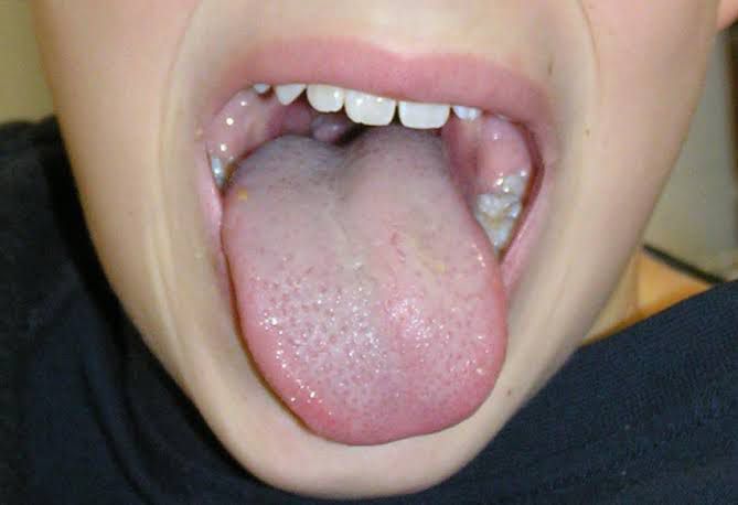 uvula deviation