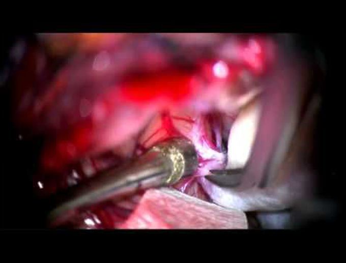 Surgical clipping of a large left middle cerebral artery aneurysm