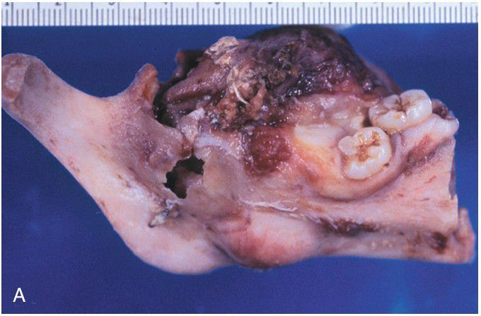 Ameloblastoma