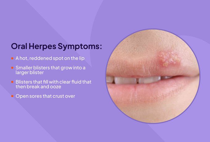 Symptoms of Herpes simplex virus