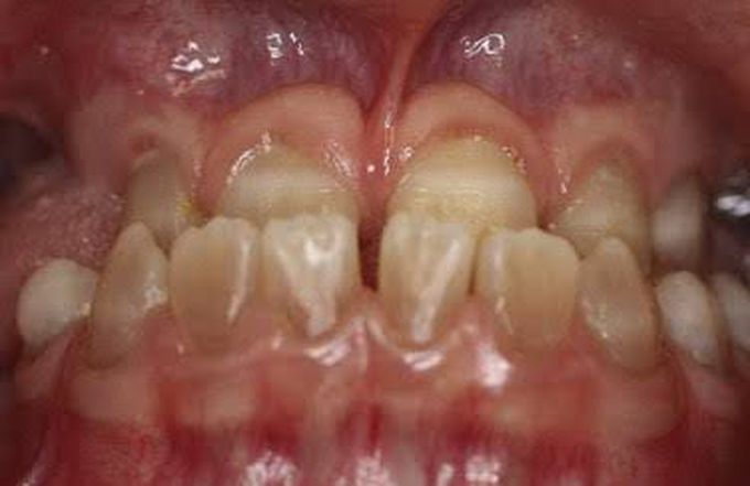 Osteogenesis Imperfecta