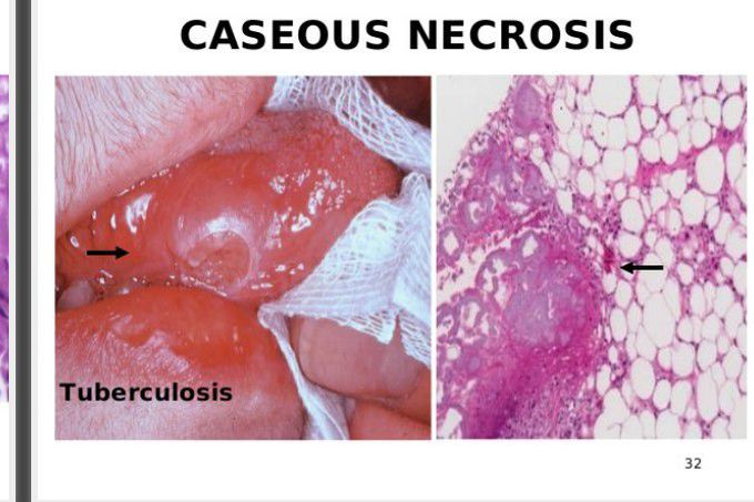 Necrosis