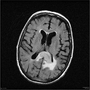 Astrocytoma (Butterfly Tumor) - MEDizzy