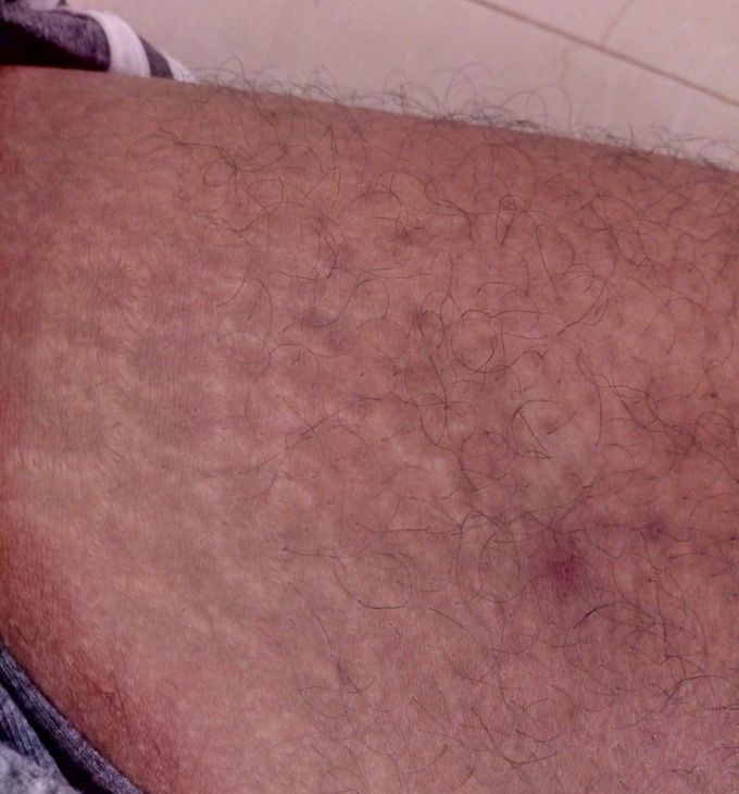 White random lines what symptoms this line ? Any birth mark or any disease