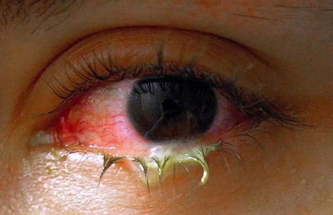 Treatment of conjunctivitis